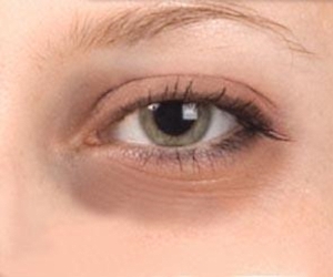 الهالات السوداء اسبابها وطرق التخلص منها Dark-Circles-under-Eyes