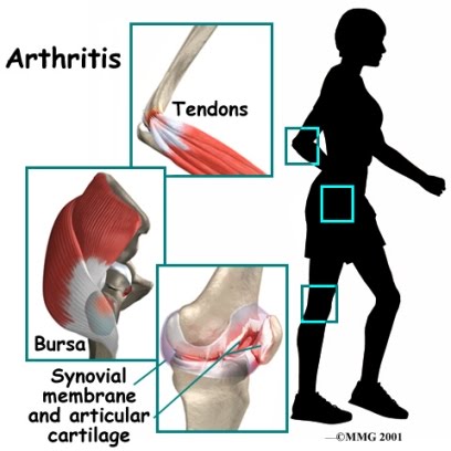 Obat Tradisional Nyeri Sendi >> 08999110405 Arthritis