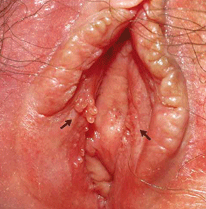 Foto de mi operación Vaginal. Picture10