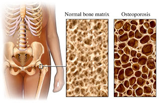 சர்க்கரை என்னும் இனிப்பு -வெள்ளை விஷம் .. Osteoporosis