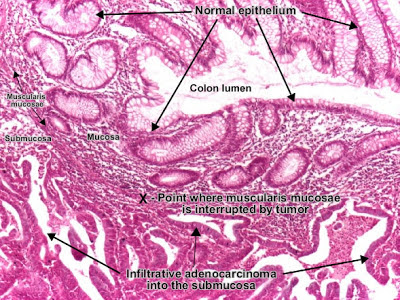 مكتبة الصور الطبية : - باثولوجى -- Pathology slides Moderatelly_differentiated_adenocarcinoma_colon