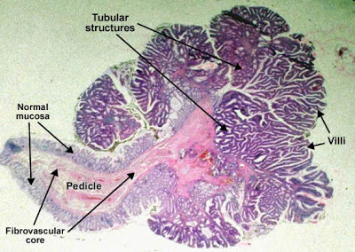 مكتبة الصور الطبية : - باثولوجى -- Pathology slides Tubulovillous_adenoma_pedunculated_polyp_colon