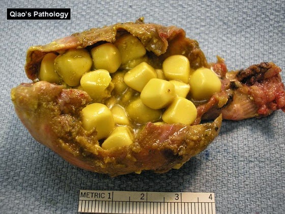 من اين ياتي  حصى المرارة؟ Cholesterol%2Bstones