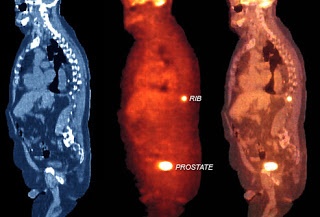 كل مايجب أن تعرفه عن سرطان البروستاتا (الجزء الثالث)... Princ_rm_photo_of_stages_of_prostate_cancer