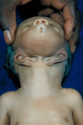 See Pics Of Baby Born With His Ears Under His Chin 1