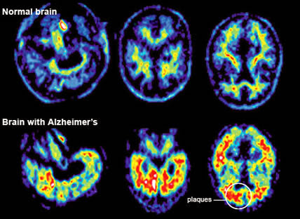 Professor: Aluminum in Food, Cosmetics and Medicine Is Poisoning Our Brains And Causing Alzheimer's Disease  Alheimersbrain3