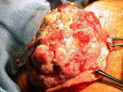 Vaccines Will be Made from Human Cancer Tumors Vaccine-tumors-630x315