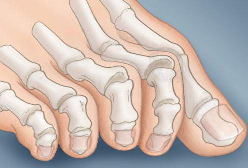 عندما تصرخ أقدامنا في الشتاء!!!! Webmd_rf_photo_of_claw_toe