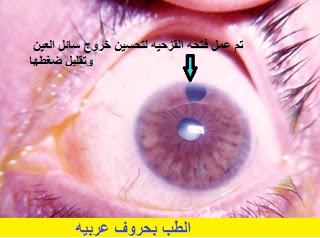 الجلوكوما Glaucoma تقنيات العلاج المختلفه AcuteGL