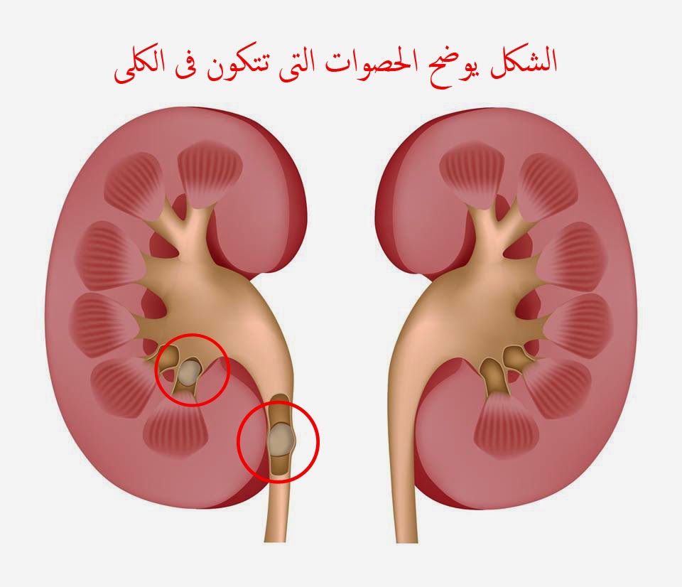 علاج الكلى |الأسباب الأكيدة لمرض الفشل الكلوى | حصى الكلى  %D8%AD%D8%B5%D9%88%D8%A7%D8%AA%2B%D8%A7%D9%84%D9%83%D9%84%D9%89%2B%D9%88%D9%83%D9%8A%D9%81%D9%8A%D8%A9%2B%D8%B9%D9%84%D8%A7%D8%AC%D9%87%D8%A7