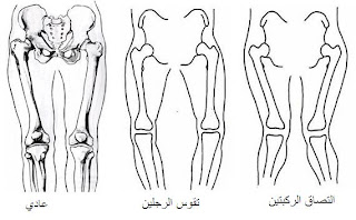 مشاكل العظام الرجلين عند الرضع  Knees1