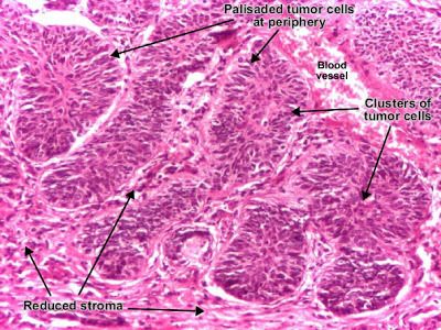 مكتبة الصور الطبية : - باثولوجى -- Pathology slides Basal_cell_carcinoma_detail