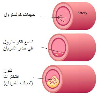 تعريف الكوليستيرول الصديق والكوليسترول العدو  وكيفية تخفيظه  002