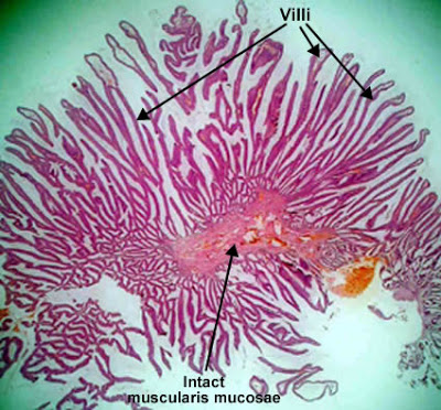 مكتبة الصور الطبية : - باثولوجى -- Pathology slides Villous_adenoma_sessile_polyp_colon