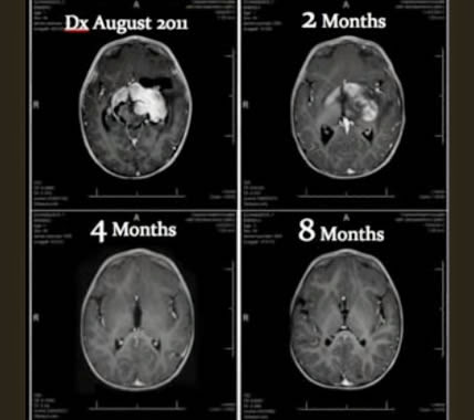 Cannabis Oil Cures 8 Month Old Infant of Cancer, Dissolving Large Inoperable Tumor In 8 Months  Tumorincenterbabyt