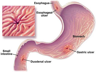 சர்க்கரை என்னும் இனிப்பு -வெள்ளை விஷம் .. Peptic-Ulcer-Disease