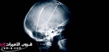 اغرب المعجزات الطبيه والغريبه في التاريخ 7