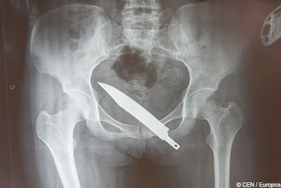 ER Visits database . Funny Stuff - Page 2 Knife_xray