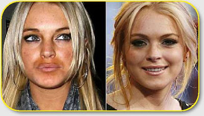 Cirugias plasticas Lohan-botox