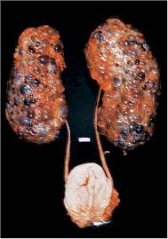 QUIZ VIRTUAL SISTEMA URINARIO (APARATO YUXTAGLOMERULAR-IRA-FUNCION ENDOCRINA RENAL) OSCAR SAURITH Ri%C3%B1%C3%B3n_insuficiencia_cr%C3%B3nica