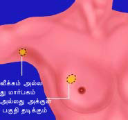 மார்பகப் புற்றுநோய் பற்றி விவரங்கள் - Lump