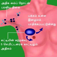 மார்பகப் புற்றுநோய் பற்றி விவரங்கள் - 2  New%2520stage3