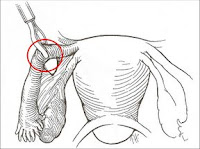 tplerin baglanmasi (tp ligasyonu)(btl) Btl