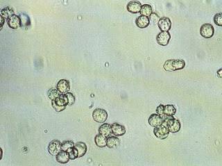  تحليل البول الكامل Complete Urine Analysis Pus