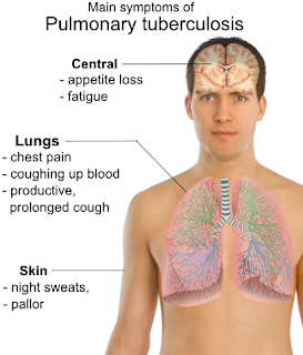 الثوم أفضل مضاد حيوي عبر التاريخ  Pulmonary_tuberculosis_symptoms