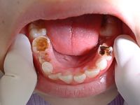 குழந்தைகளுக்கு வரும் வாய் புண் மற்றும் துர் நாற்றம்  Pediatric_cavities1