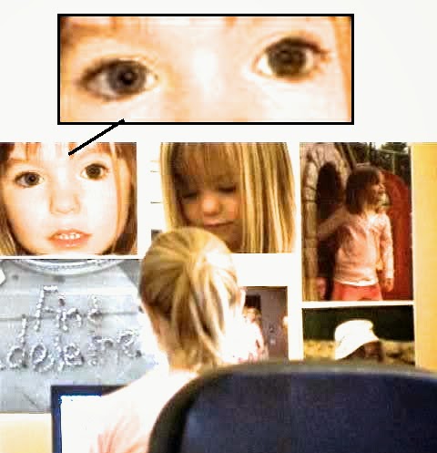 colobomaJust - The changing Coloboma of Madeleine MaddieNoColoboma1