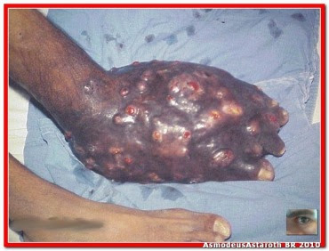 [OFF-Topic] KROKODIL:A droga zumbi russa que faz viciados Apodrecerem  Krokodil2