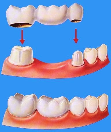 Quy trình bọc răng sứ tại trung tâm nha khoa Quy-trinh-boc-rang-su-cho-nha-khoa-2