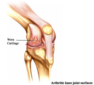 خشونة الركبة لدى كبار السن تتأثر بالعوامل النفسية Osteoarthritis1