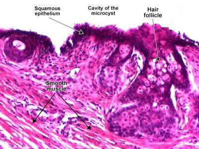 مكتبة الصور الطبية : - باثولوجى -- Pathology slides Benign_microcystic_teratoma_ovary_02