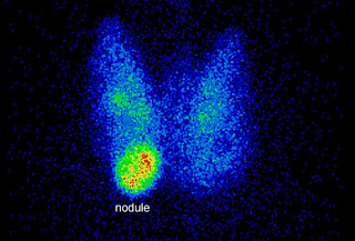 اختلال هرمونات الغده الدرقيه ...الاعراض والعلاج  Phototake_rm_photo_of_thyroid_nodule