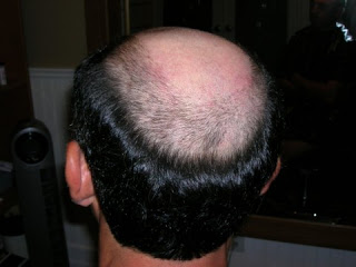 علاج الصلع  Male_Pattern_Baldness_in_combination_with_Alopecia_Areata