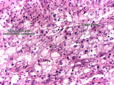 مكتبة الصور الطبية : - باثولوجى -- Pathology slides Renal_cell_carcinoma_grawitz_tumor
