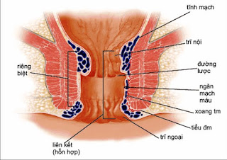 Kiến thức tổng quát về bệnh trĩ ngoại Tong-quan-benh-tri-ngoai