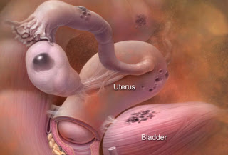 ما هي الام أسفل البطن عند الإناث Phototake_rm_photo_of_endometriosis