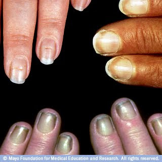 هل تشير أظافرك إلى مشكلة صحية؟  Nail1