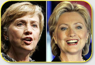 Cirugias plasticas Clinton-botox