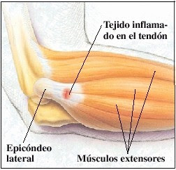 Lesiones en los codos Epicondilitis