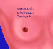 மார்பகப் புற்றுநோய் பற்றி விவரங்கள் - Retraction