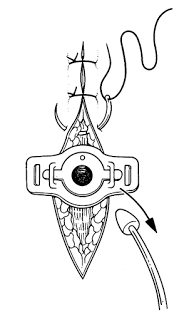 Tracheostomy & Cricothyrotomy بالصور 16.24