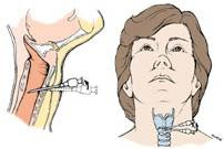 Tracheostomy & Cricothyrotomy بالصور Cricothyrotomy