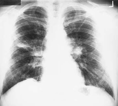 MEDICAL CASE No. 1 CXR1