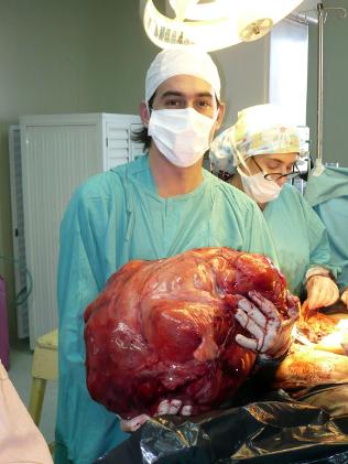 ஆச்ச‌ர்ய‌மான‌ அறுவை    Argentina-tumor