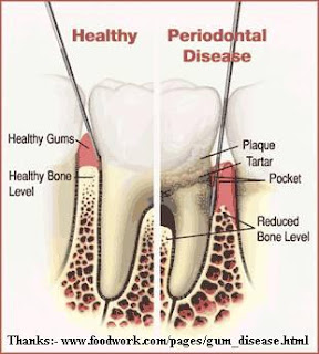 வாய்நாற்றம் ஏன் ஏற்படுகிறது? - Halitosis Periodontal_Disease