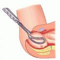 குழந்தை பிறப்புக்கு உதவும் கருவிகள் Forceps